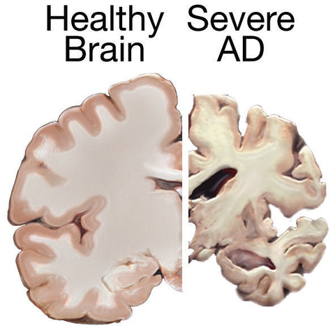 What Is Alzheimer's Disease?